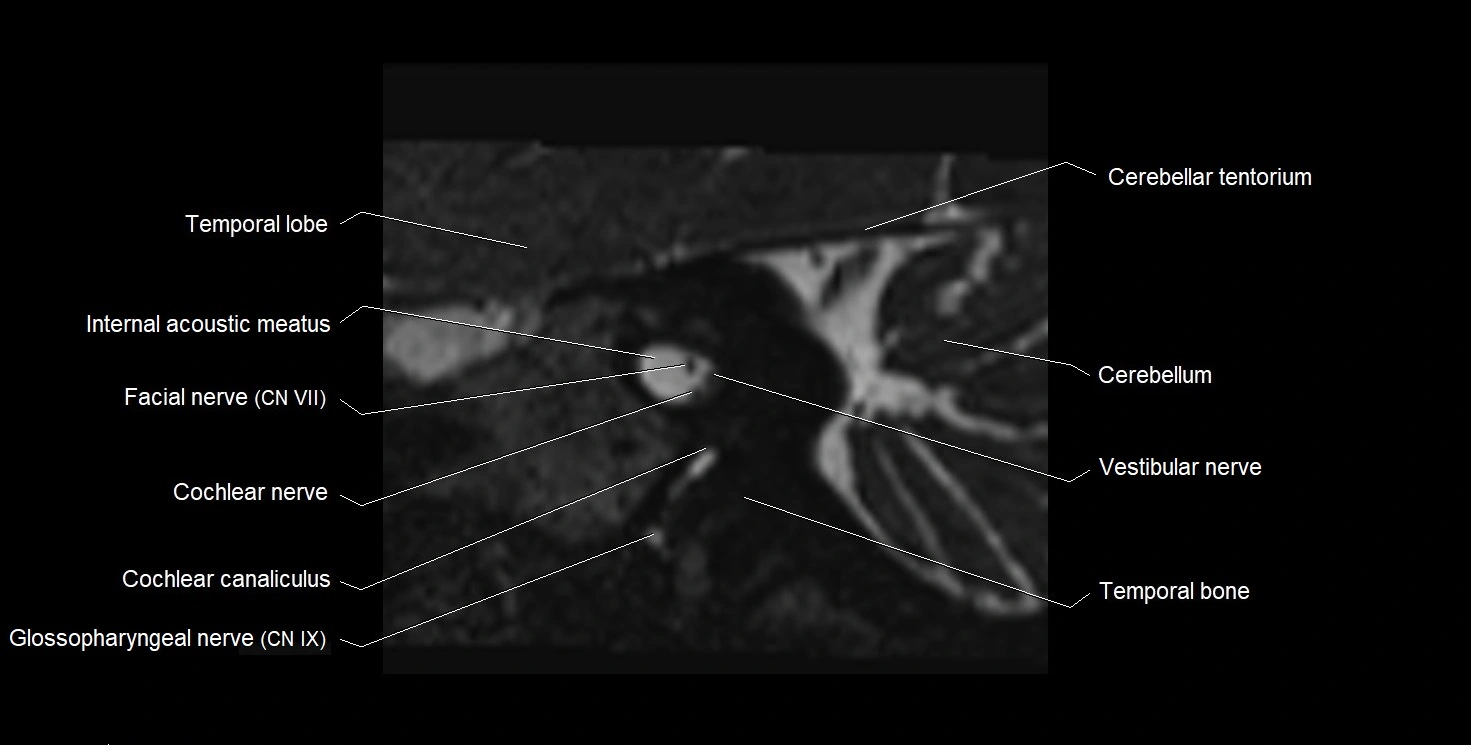Internal auditory meatus (IAM) 3T sagittal cross sectional anatomy image 21.webp